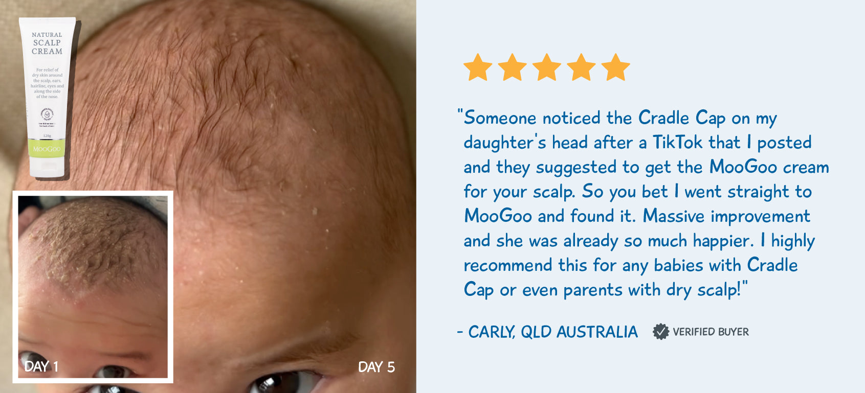 Cradle Cap