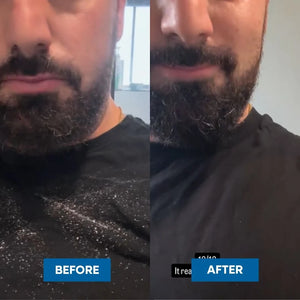 A side-by-side before and after comparison of a man's beard, showing less flakes on his shirt after using the MooGoo Flake Free Anti-Dandruff Shampoo. 