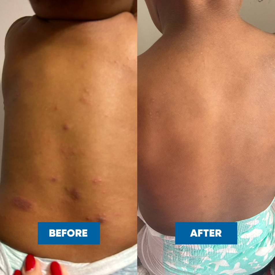 Before and after comparison of a childs back with visible improvements after using the MooGoo Sensitive Skin Balm and Soothing MSM Moisturiser on his discoid eczema.