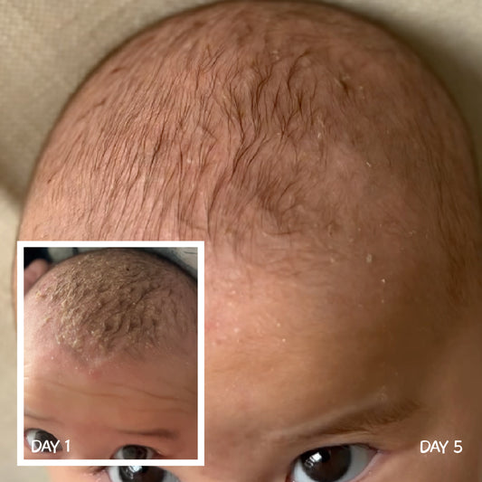 Before and after of baby scalp showing cradle cap improvement from day 1 to day 5, relief of dry, flaky and irritated skin with MooGoo natural care formula