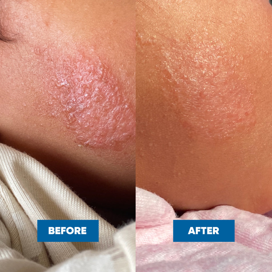 Before and after comparison of a child's cheek, showing eczema skin condition improvement after using the Eczema & Psoriasis Cream.