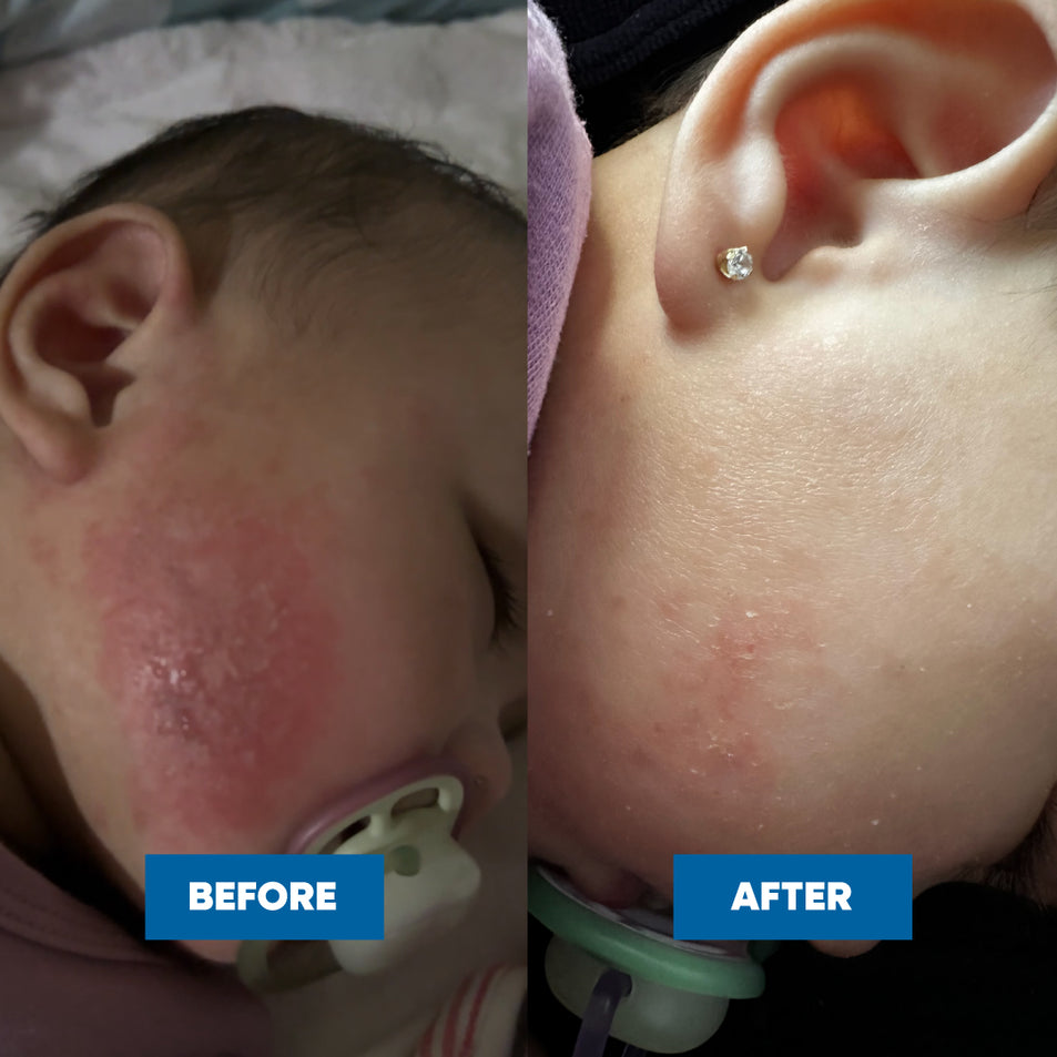 Before and after comparison of a child's cheek, showing eczema skin condition improvement after using the Eczema & Psoriasis Cream.
