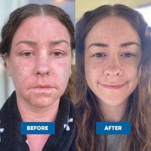 Before and after comparison of a woman's face with visible improvements from Topical Steroid Withdrawal after using the MooGoo Pink Eczema Cream.