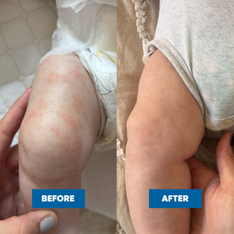 Before and after comparison of a child's knee with Eczema, showing improvement after using the MooGoo Pink Eczema Cream.