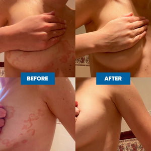 Before and after comparison of a a woman's skin with visible patches of Eczema, showing an amazing transformation after using the MooGoo Eczema & Psoriasis Cream with Marshmallow, Elderberry & More.