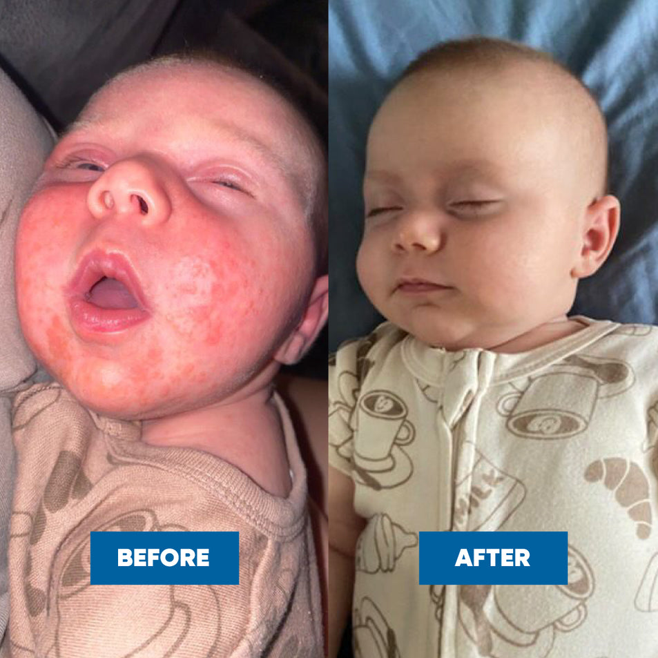 Before and after comparison of a baby's skin with visible patches of Eczema, showing an amazing transformation after using the MooGoo Eczema & Psoriasis Cream with Marshmallow, Elderberry & More and Soothing MSM Moisturiser.