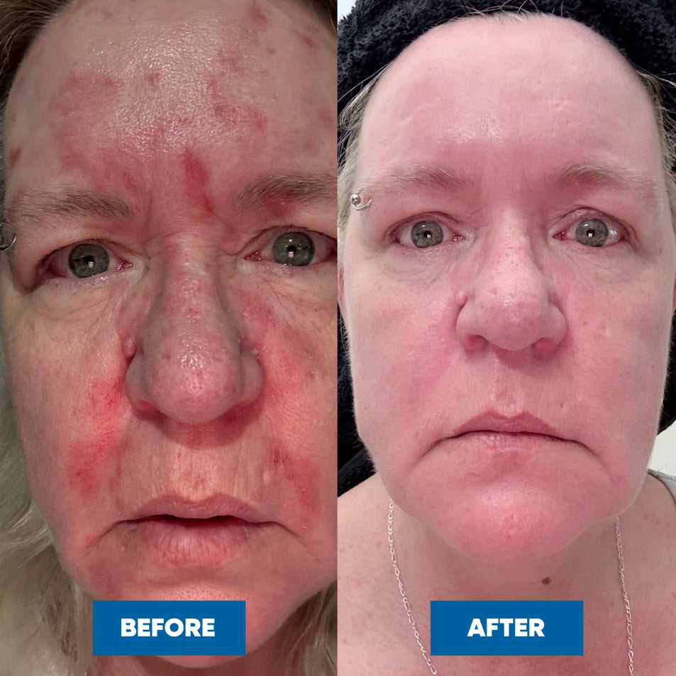 Before and after comparison of a woman's skin with visible patches of Eczema, showing an amazing transformation after using the MooGoo Eczema & Psoriasis Cream with Marshmallow, Elderberry & More.